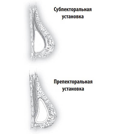виды установки грудного имплантата