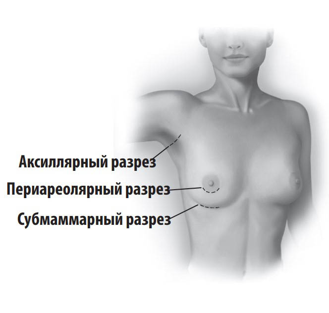 типы разрезов при пластике груди