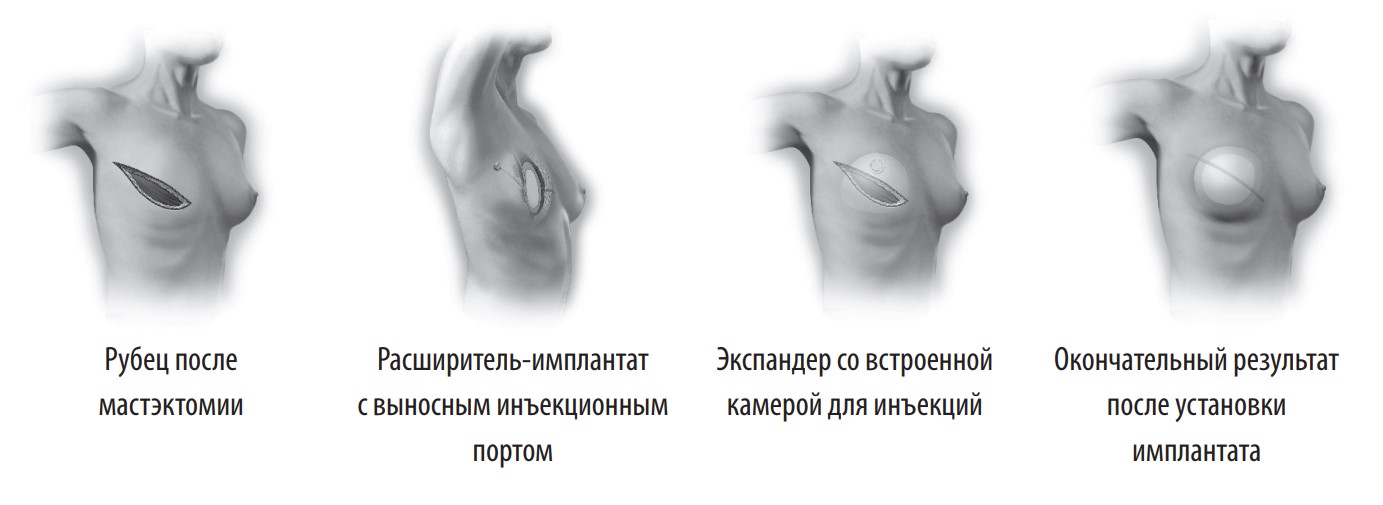 виды расширения тканей при установке грудного имплантата