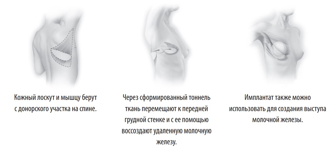 метод реконструкции груди торакодорзальным лоскутом